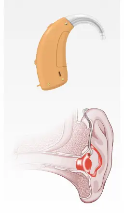 BTE Behind-the-Ear Hearing Aid