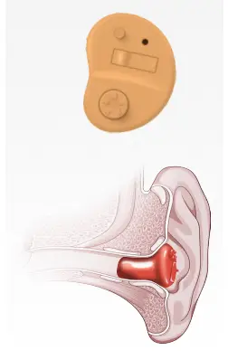 ITC in-the-canal hearing aid