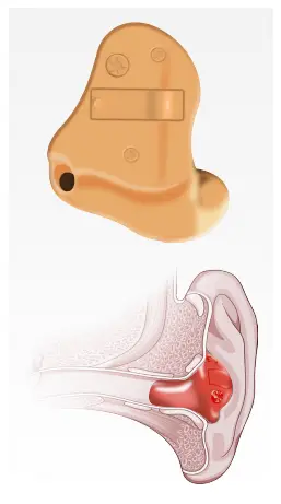 ITE In-the-ear hearing aid