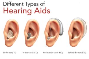 The wearing effects of different types of hearing AIDS