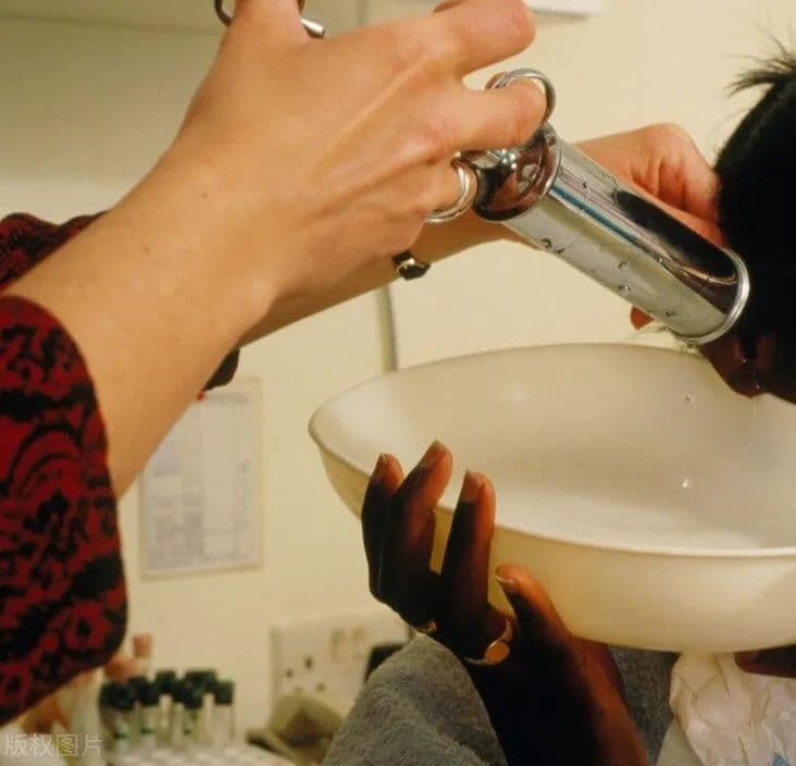 Traditional irrigation of the external auditory canal
