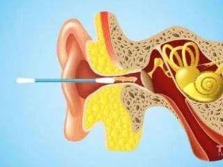 Use cotton swabs to clean earwax